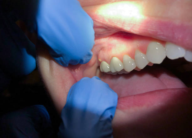 Best Dentist for Tooth Abscess  in Cullman, AL