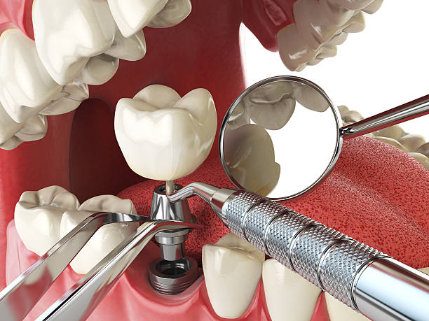 Emergency Dental Filling Replacement in AL